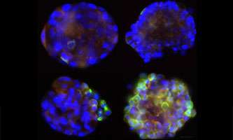 Study paves the way for better understanding how prostate cancer spreads around the body