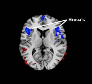 Stuttering linked to reduced blood flow in area of brain associated with language