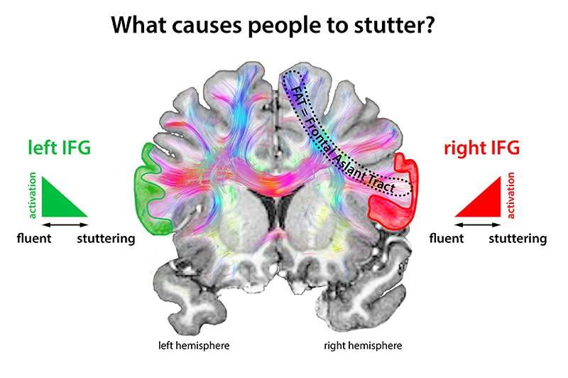 Stuttering: Stop signals in the brain disturb speech flow