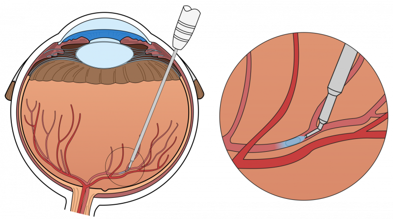 Surgical eye robot performs precision-injection in patient with retinal vein occlusion