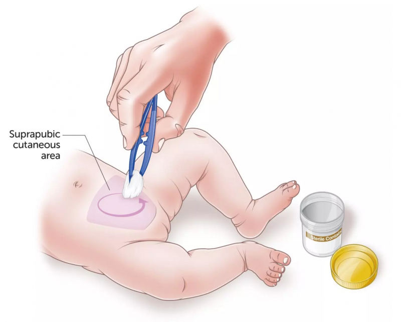 Technique to quickly acquire urine samples from infants