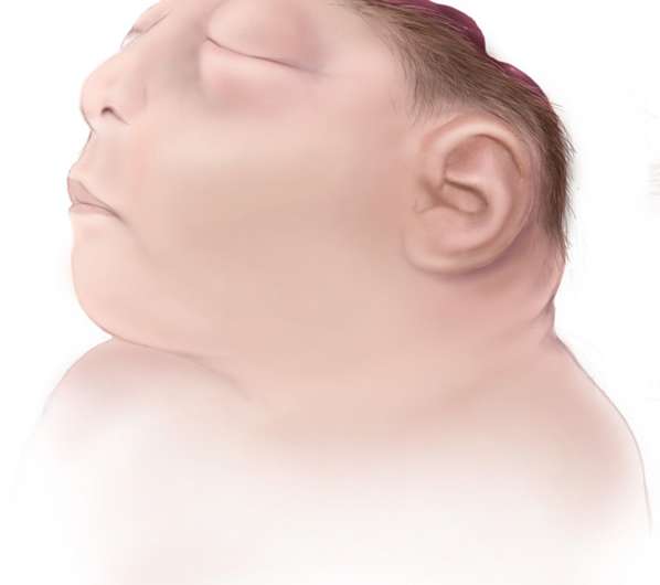 The AHCA and anencephaly