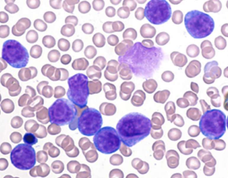 Tumor suppressor promotes some acute myeloid leukemias, study reveals