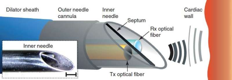 Ultrasound imaging needle to transform heart surgery
