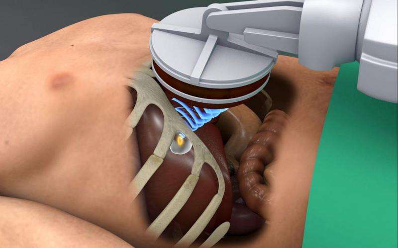 Ultrasound scalpel destroys liver tumors