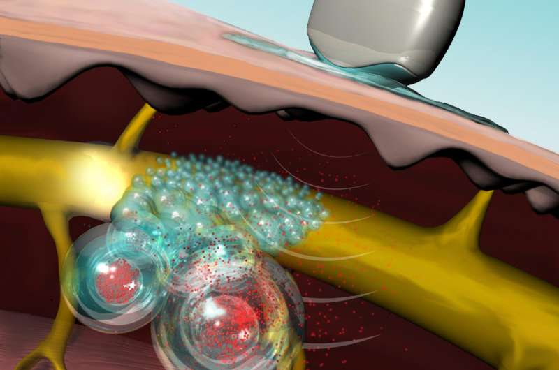 Ultrasound-triggered liposomes for on-demand, local anesthesia