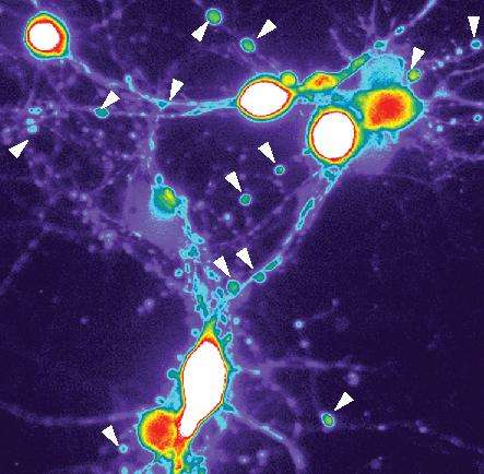 Unraveling Alzheimer's: New study documents how brain cells go bad