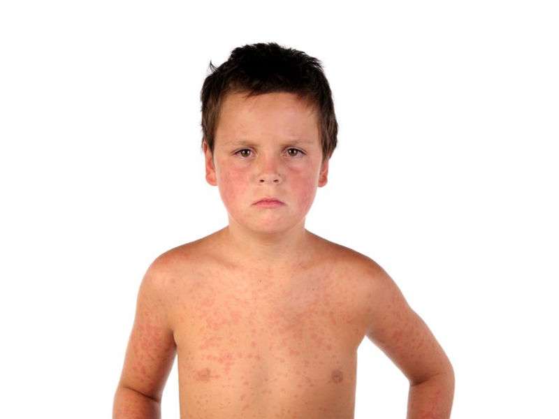 Unusual measles outbreak described in ontario in early 2015