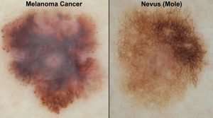 Using computers to aid melanoma detection