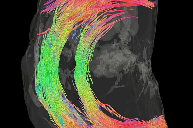 Using MRI to understand why some women go into early labor