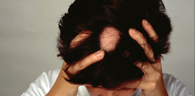 What causes alopecia areata and can you treat this type of hair loss?