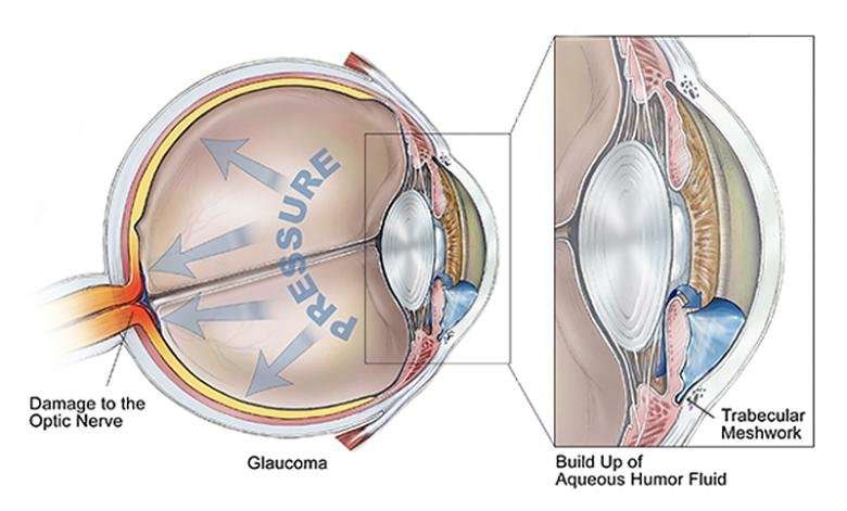 'Y' a protein unicorn might matter in glaucoma