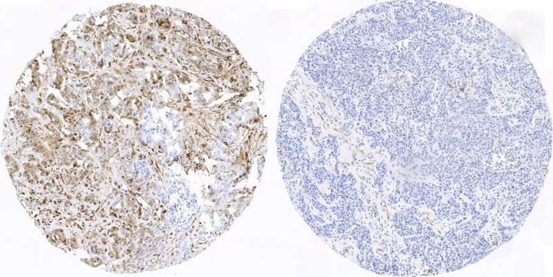 CNIO researchers find first indicators of prognosis for the most aggressive breast cancer