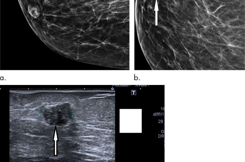 Digital mammography increases breast cancer detection