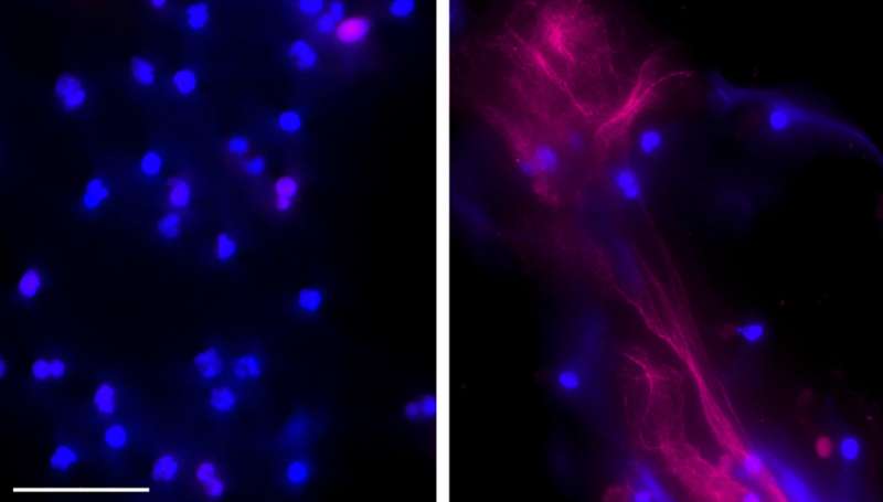 DNA 'webs' aid ovarian cancer metastasis, study reveals