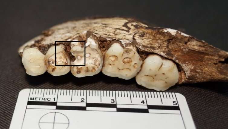 Human ancestors had the same dental problems as us – even without fizzy drinks and sweets