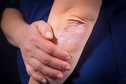 Insight into potential new strategy to target skin diseases like psorias