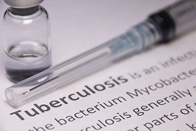 New blood test found to predict onset of TB up to two years in advance
