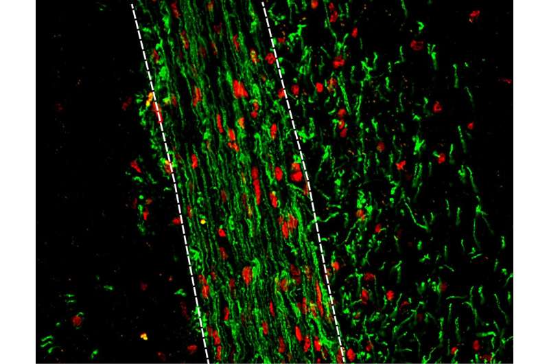 New drug target for remyelination in MS is identified by UB researchers