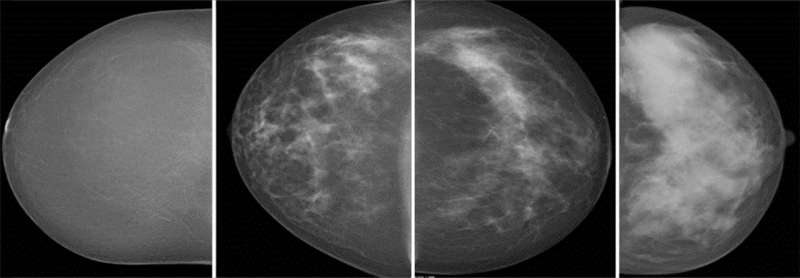 New study confirms higher cancer rate in women with dense breast tissue