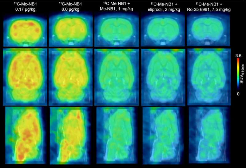 Novel PET imaging agent could help guide therapy for brain diseases