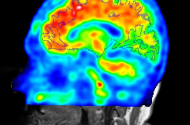 Novel strategy shows promise for earlier detection of Alzheimer's disease