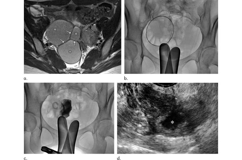 Novel technique to treat endometrial cysts is safe and effective