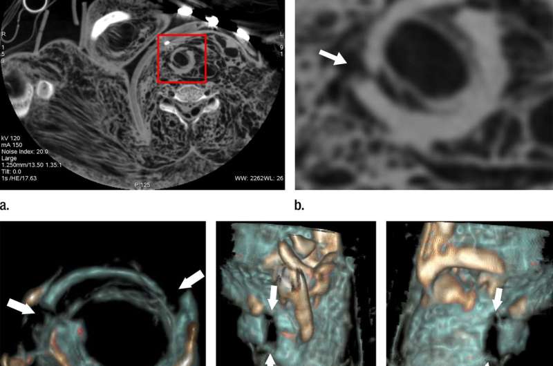 Post-mortem CT angiography illuminates causes of death