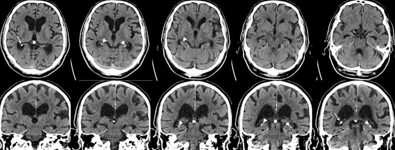 Smoking and diabetes linked to brain calcifications