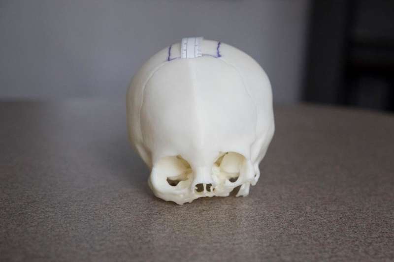 Surgeon uses 3-D printed skulls to prepare for delicate procedures