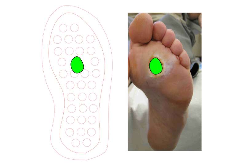 Ulcers from diabetes? New shoe insole could provide healing on-the-go