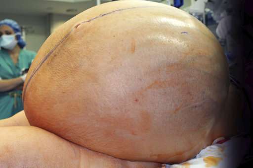 132-pound tumor removed from woman's abdomen