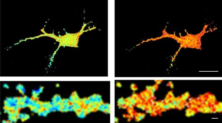 Alzheimer's disease: How amyloid aggregates alter neuronal function