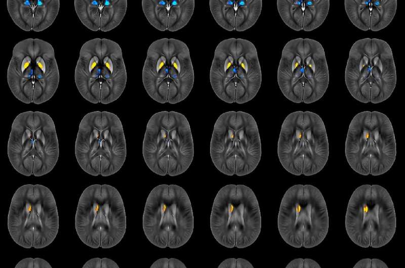 Brain iron levels may predict multiple sclerosis disabilities