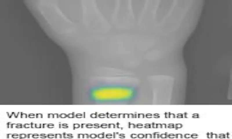 Deep neural network improves detection of wrist fractures