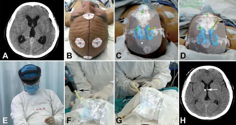 Holographic images increase accuracy of external ventricular drain insertion