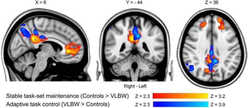 How very low birth weight affects brain development