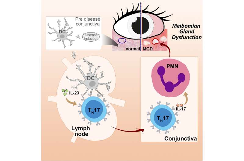 Immune response likely culprit in eyelid gland condition that causes dry eye