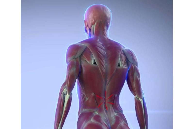 Pulsed radiofrequency relieves acute back pain and sciatica
