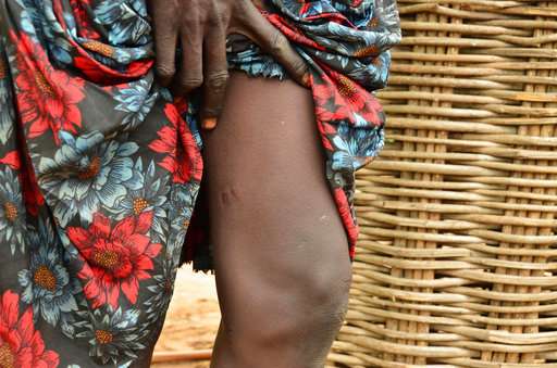 World moves closer to eradicating Guinea worm disease