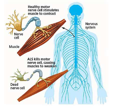 Researchers close to understanding 'disease mechanisms' of ALS