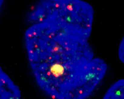 Newly identified genetic markers classify previously undetermined glioblastoma tumors