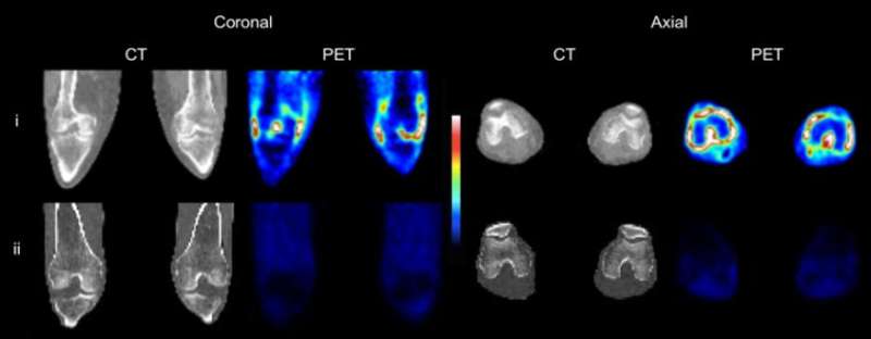Novel PET imaging method more fully evaluates extent of rheumatoid arthritis inflammation