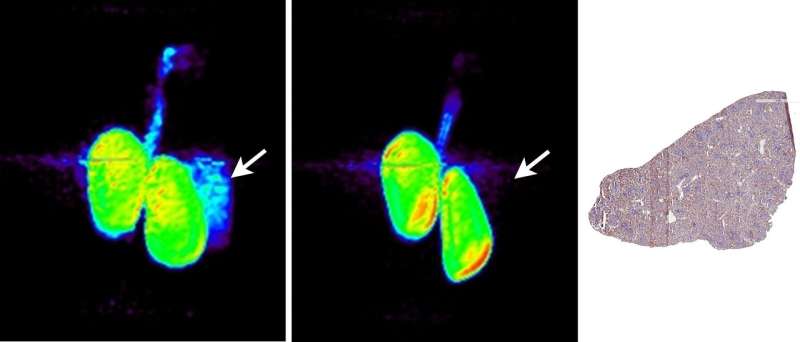 Researchers develop new approach that uses single PET scan to personalize cancer treatment