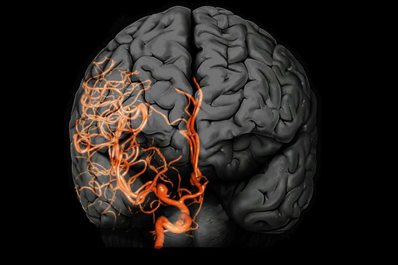 Researchers use sound and visuals to simulate blood-flow patterns of brain aneurysms