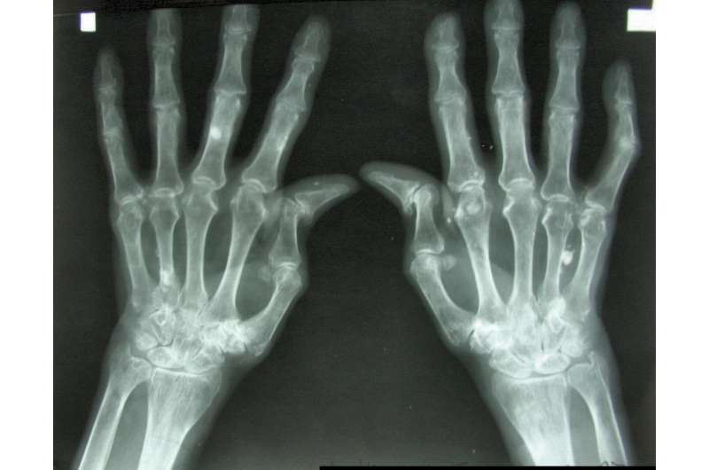 3D-printed living tissues could spell the end of arthritis