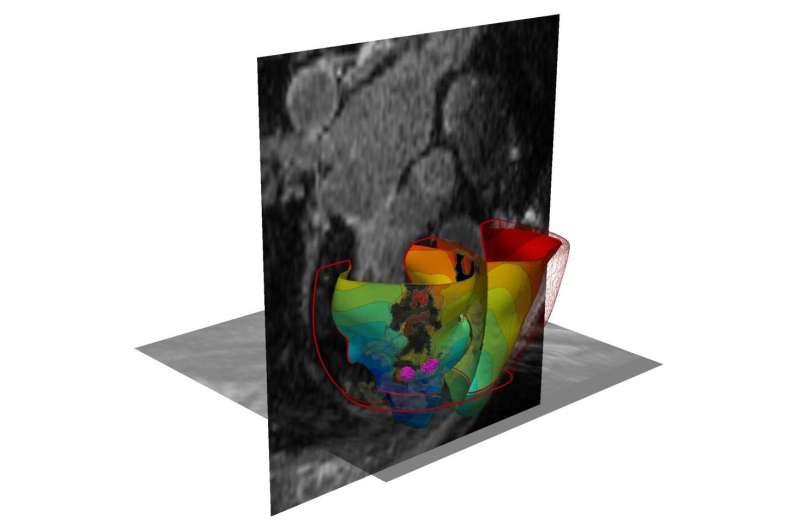 3D virtual simulation gets to the 'heart' of irregular heartbeats