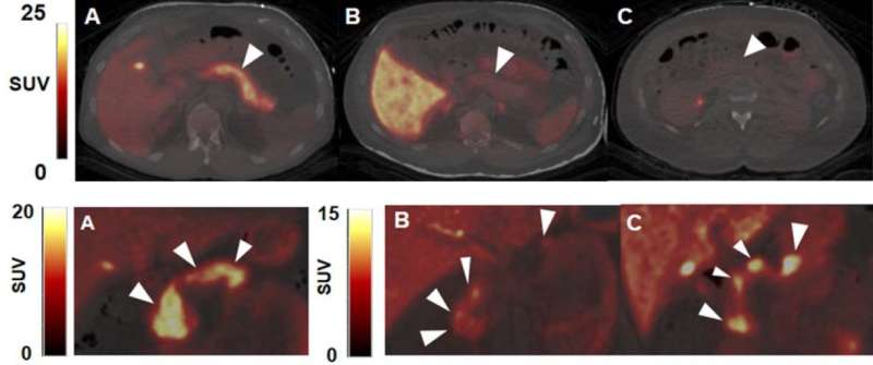 Novel PET imaging method could track and guide therapy for type 1 diabetes