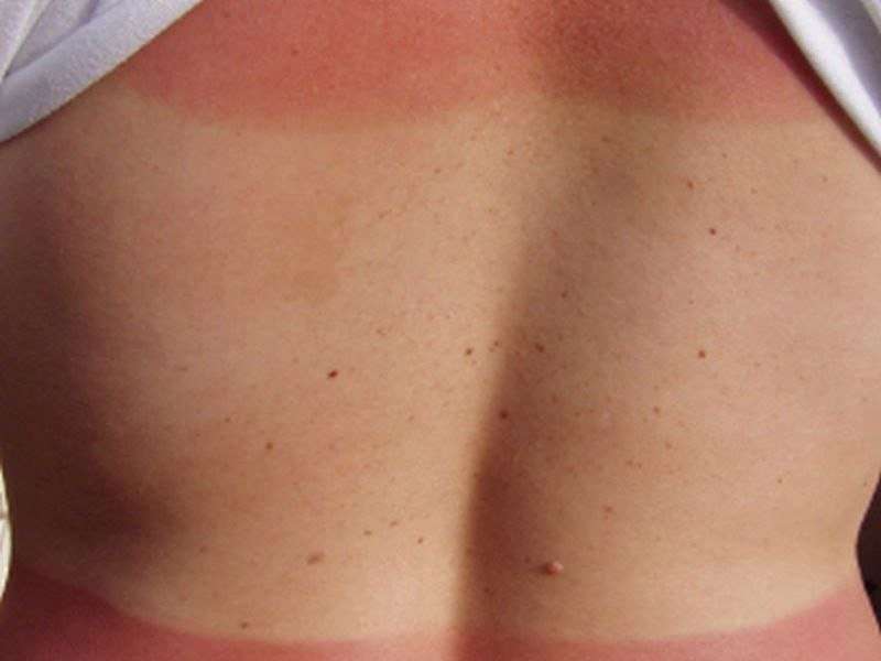 Prevalence of sunburn 34.2 percent in U.S. in 2015