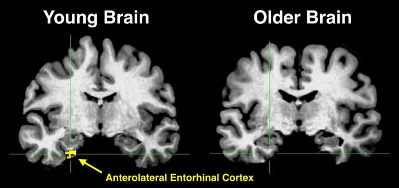 High-resolution brain imaging provides clues about memory loss in older adults